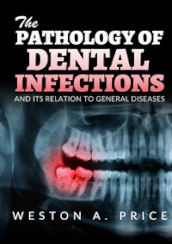 The pathology of dental infections and its relation to general diseases